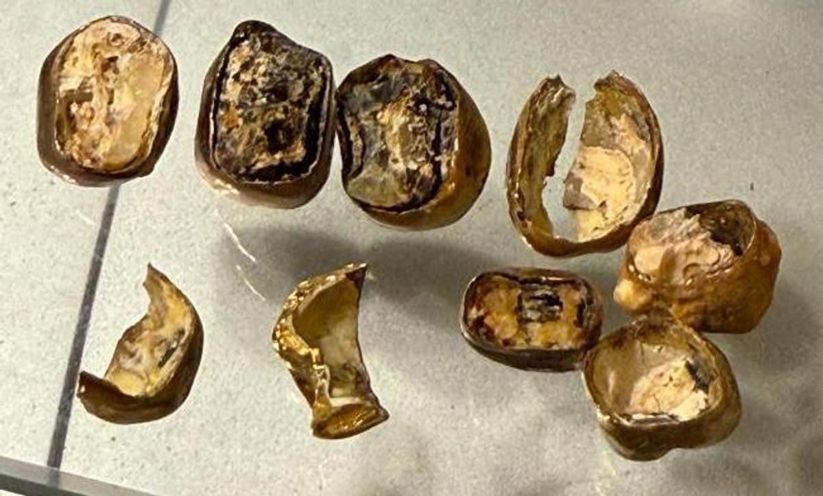 21 Grams - Gold Fillings, Some Enamel Remnants to Take Into Consideration