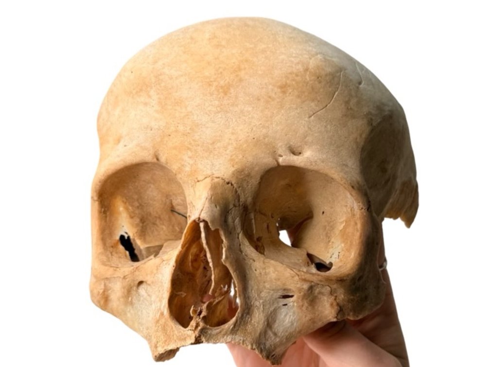 Genuine Human Partial Skull